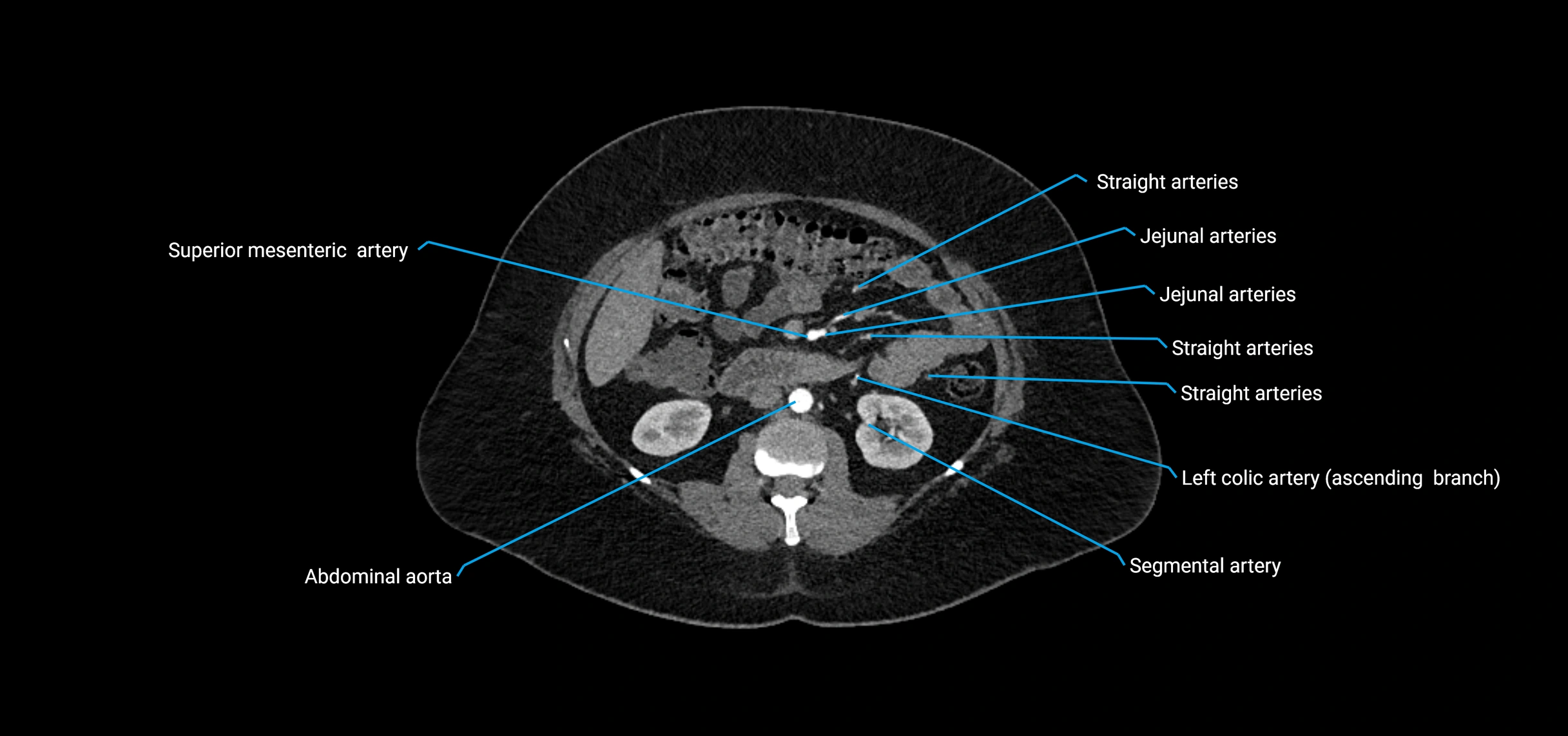 CTA abdomen axial cross sectional anatomy labelled image_85 (2).webp